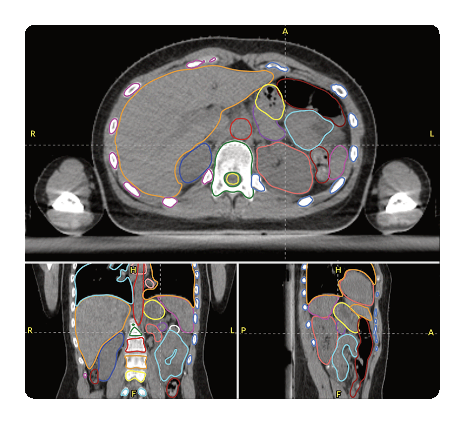 CT SCAN